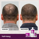 Umfassende Behandlung gegen Haarausfall Hairmacy